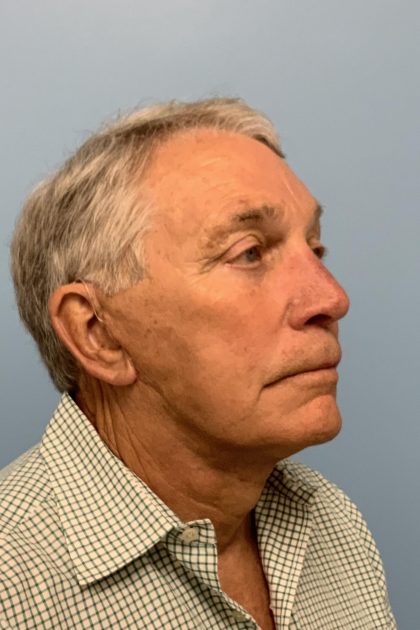 Upper Blepharoplasty Before & After Patient #13772