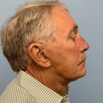 Upper Blepharoplasty Before & After Patient #13772