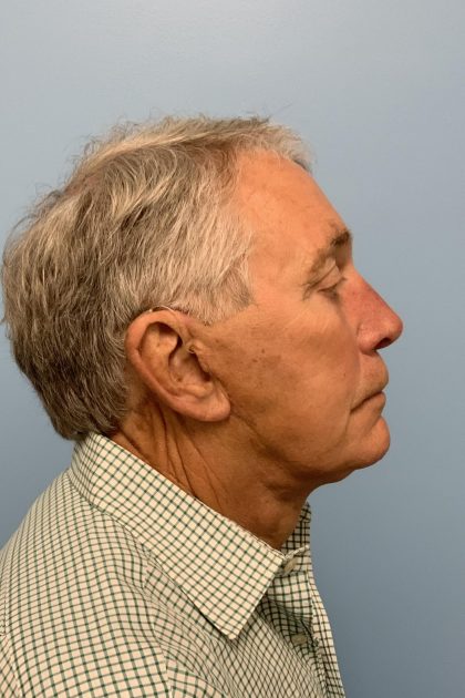 Upper Blepharoplasty Before & After Patient #13772