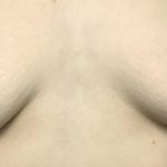 Inverted Nipple Repair (Papuloplasty) Before & After Patient #13786
