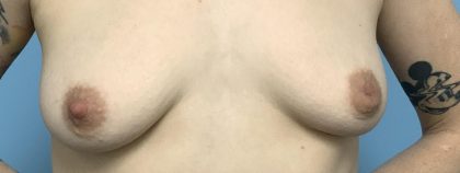 Inverted Nipple Repair (Papuloplasty) Before & After Patient #13786