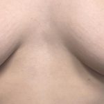 Inverted Nipple Repair (Papuloplasty) Before & After Patient #13786