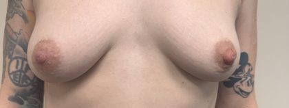 Inverted Nipple Repair (Papuloplasty) Before & After Patient #13786