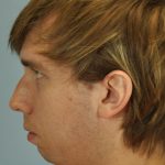 Nose Surgery Before & After Patient #13801