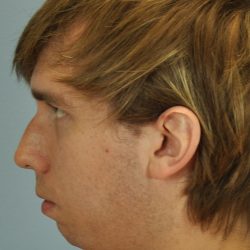 Nose Surgery Before & After Patient #13801