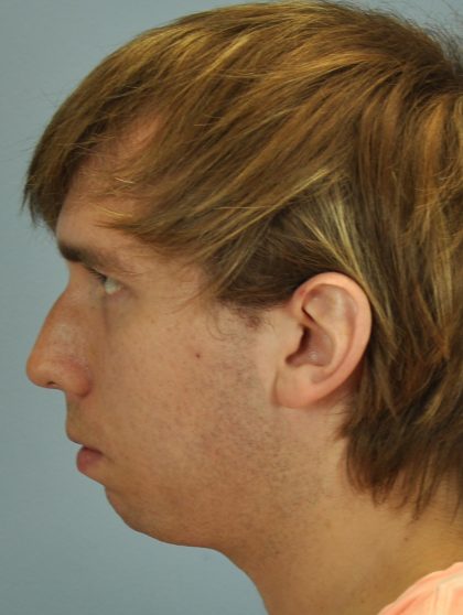 Nose Surgery Before & After Patient #13801