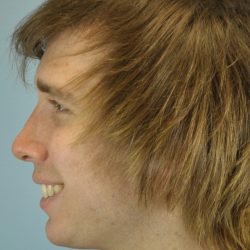 Nose Surgery Before & After Patient #13801