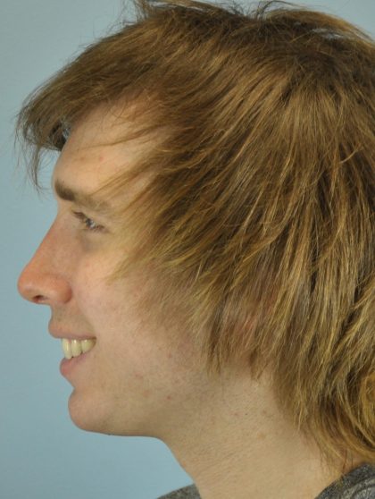 Nose Surgery Before & After Patient #13801
