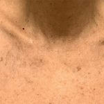 BBL Forever Young Before & After Patient #13807