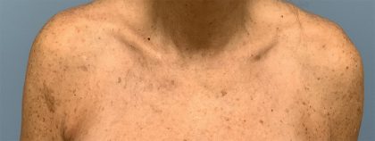 BBL Forever Young Before & After Patient #13807