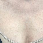 BBL Forever Young Before & After Patient #13807