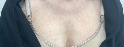 BBL Forever Young Before & After Patient #13807