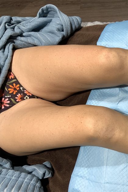 BBL Forever Young Before & After Patient #13807