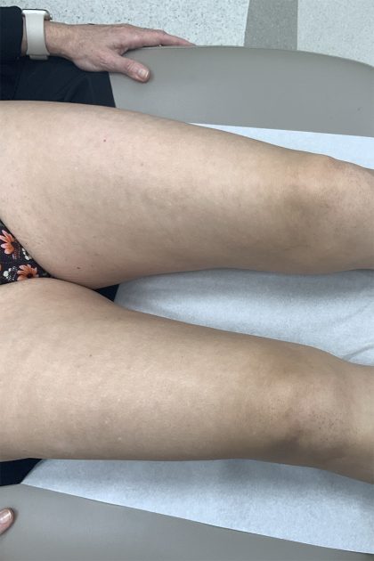 BBL Forever Young Before & After Patient #13807