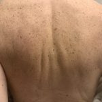BBL Forever Young Before & After Patient #13807