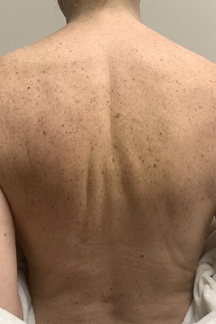 BBL Forever Young Before & After Patient #13807