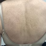 BBL Forever Young Before & After Patient #13807