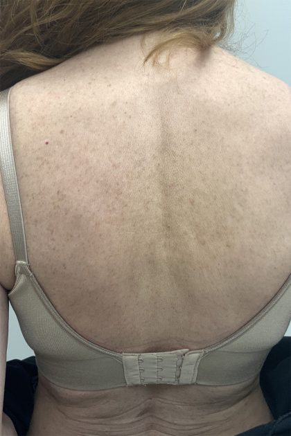BBL Forever Young Before & After Patient #13807